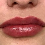 Aumento de labios Antes y Después Paciente #418