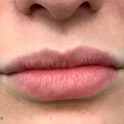 Lip Augmentation Before & After Patient #418