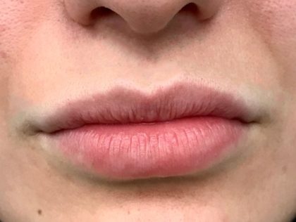 Увеличение губ до и после Пациентка №418