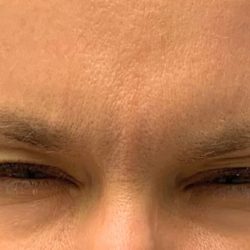 Glabella Before & After Patient #438