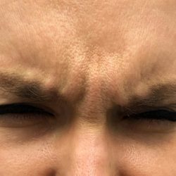 Glabella Before & After Patient #438