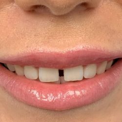 Gummy Smile Before & After Patient #443