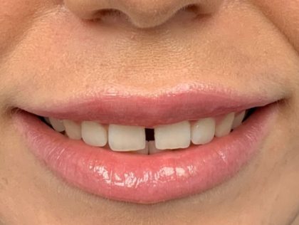 Sonrisa gingival Antes y Después Paciente #443