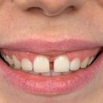 Sonrisa gingival Antes y Después Paciente #443