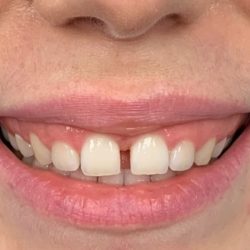 Gummy Smile Before & After Patient #443
