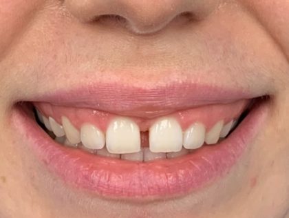 Gummy Smile Before & After Patient #443