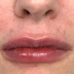 Lip Augmentation Before & After Patient #416