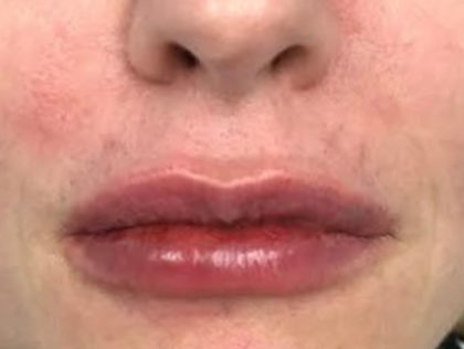 Увеличение губ до и после Пациентка №416