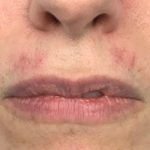 Aumento de labios Antes y Después Paciente #416