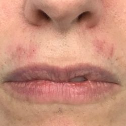 Lip Augmentation Before & After Patient #416