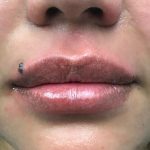 Увеличение губ до и после Пациентка №419