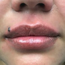 Lip Augmentation Before & After Patient #419