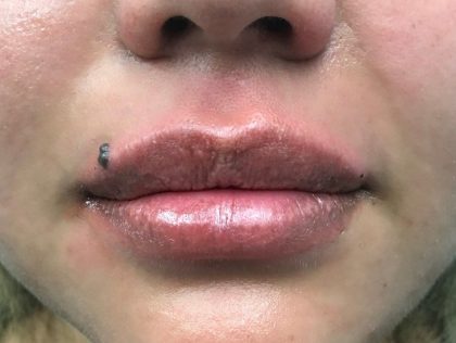 Увеличение губ до и после Пациентка №419