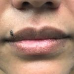 Aumento de labios Antes y Después Paciente #419