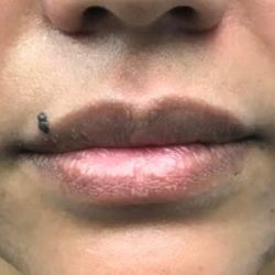 Lip Augmentation Before & After Patient #419
