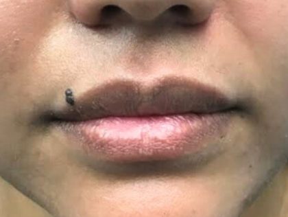 Lip Augmentation Before & After Patient #419