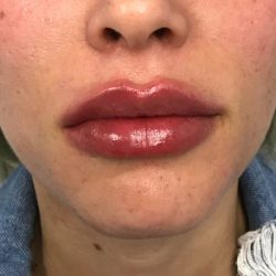Lip Augmentation Before & After Patient #72