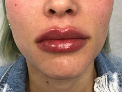 Lip Augmentation Before & After Patient #72