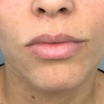 Lip Augmentation Before & After Patient #72