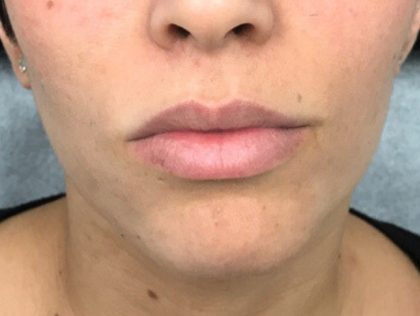 Увеличение губ до и после Пациентка №72