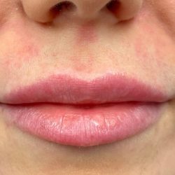 Lip Augmentation Before & After Patient #76