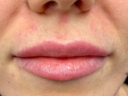 Aumento de labios Antes y Después Paciente 76