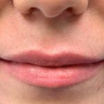 Aumento de labios Antes y Después Paciente 76