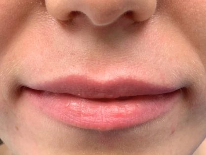 Увеличение губ до и после Пациентка №76