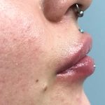 Aumento de labios y mentón Antes y después Paciente 447