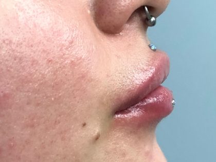 Lip & Chin Augmentation Before & After Patient #447