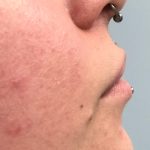 Aumento de labios y mentón Antes y después Paciente 447