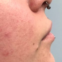 Lip & Chin Augmentation Before & After Patient #447