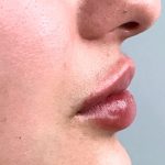 Lip Augmentation Before & After Patient #417