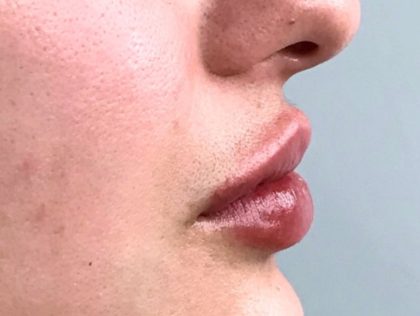 Lip Augmentation Before & After Patient #417