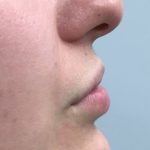 Aumento de labios Antes y Después Paciente 417