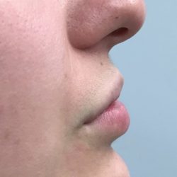 Lip Augmentation Before & After Patient #417