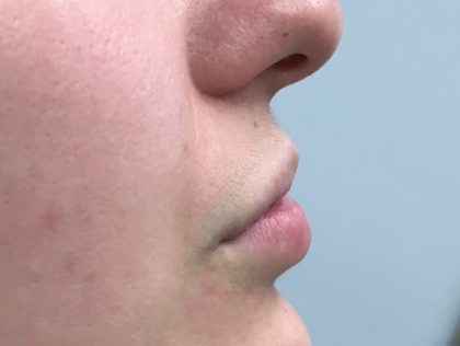 Увеличение губ до и после Пациентка №417