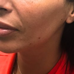 Sculptra-Midface Before & After Patient #451