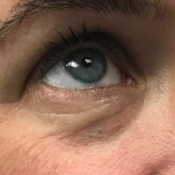 Under Eye Rejuvenation Before & After Patient #454