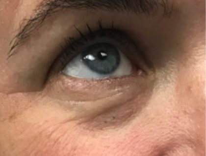 Under Eye Rejuvenation Before & After Patient #454