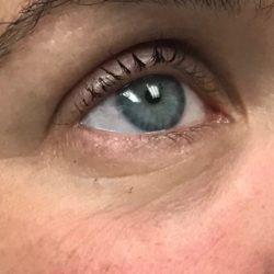 Under Eye Rejuvenation Before & After Patient #454