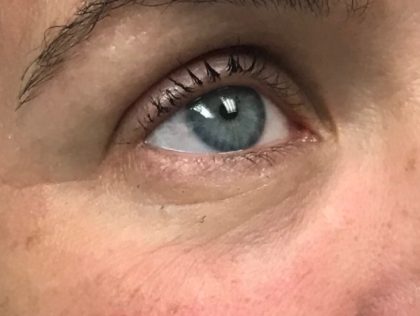 Under Eye Rejuvenation Before & After Patient #454