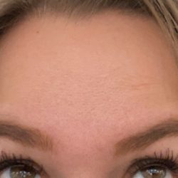 Botox Before & After Patient #435