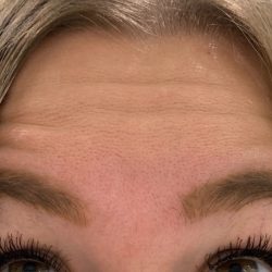 Botox Before & After Patient #435