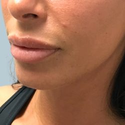 Sculptra-Midface Before & After Patient #451