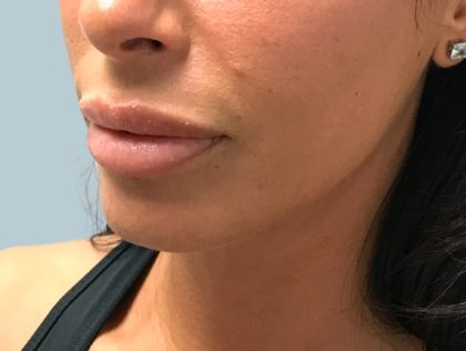Sculptra-Midface Antes y después Paciente 451
