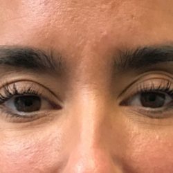 Under Eye Rejuvenation Before & After Patient #458