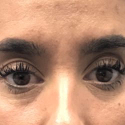 Under Eye Rejuvenation Before & After Patient #458