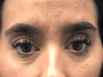 Under Eye Rejuvenation Before & After Patient #458